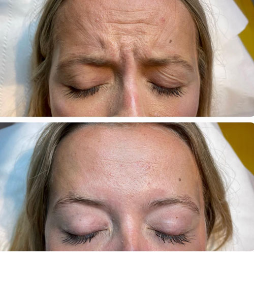 anti wrinkle injections in Mayfield